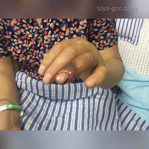 男子被蝮蛇咬伤凸显血清短缺问题